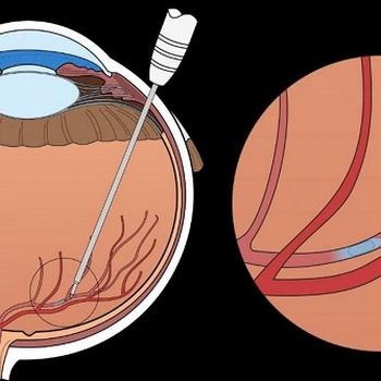 Eye Surgery Robot