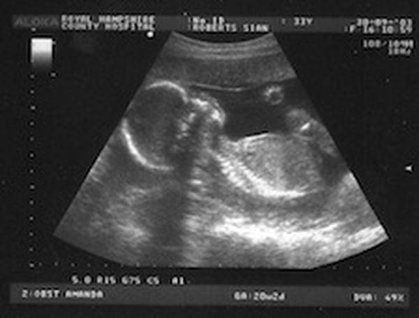 Scans of baby