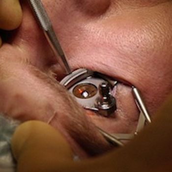 Laser eye surgery