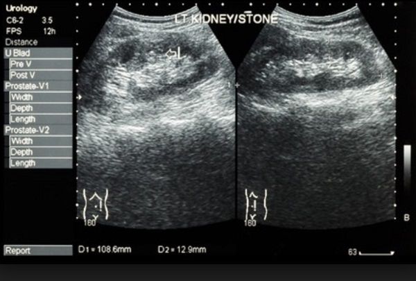 Kidney stones