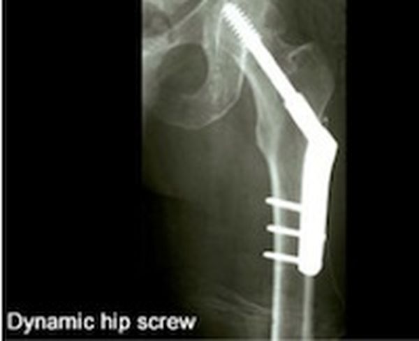 Metal screw is placed in the bone