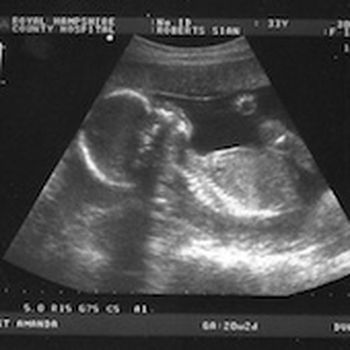 Scans of baby