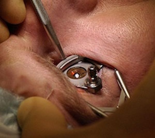 Laser eye surgery