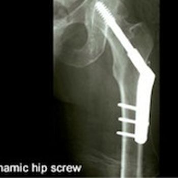 Metal screw is placed in the bone