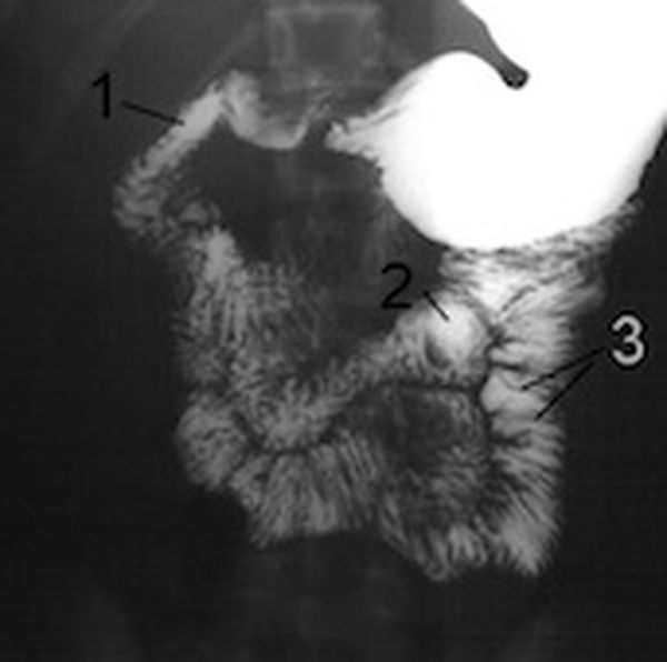 Barium is introduced into the intestine before having an x-ray