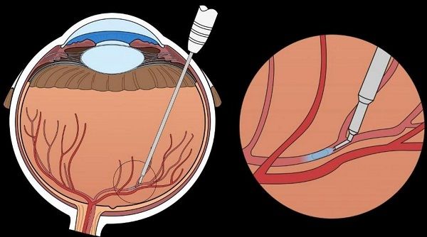 Eye Surgery Robot
